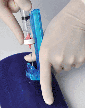 Image: The AxoTrack needle guidance ultrasound probe (Photo courtesy of Terason / Soma Access Systems). Image: The AxoTrack needle guidance ultrasound probe (Photo courtesy of Terason / Soma Access Systems).